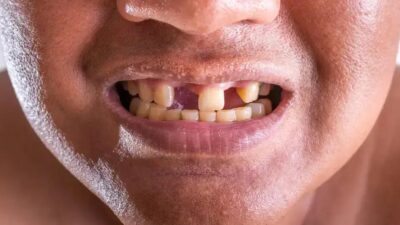 A palavra-chave do artigo é "droga que pode regenerar dentes humanos ausentes finalmente entra em testes clínicos".