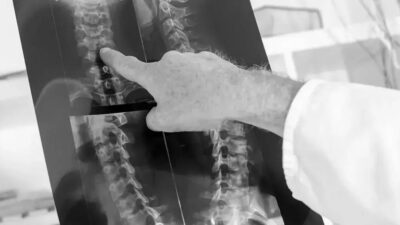 Medicamento brasileiro pode ajudar na recuperação de movimentos após lesões na medula
