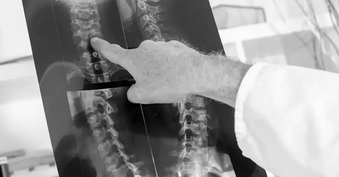 Medicamento brasileiro pode ajudar na recuperação de movimentos após lesões na medula