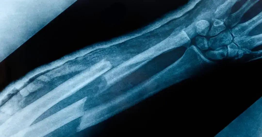 Pesquisadores testam 'pistola de cola quente' para conserto de ossos quebrados